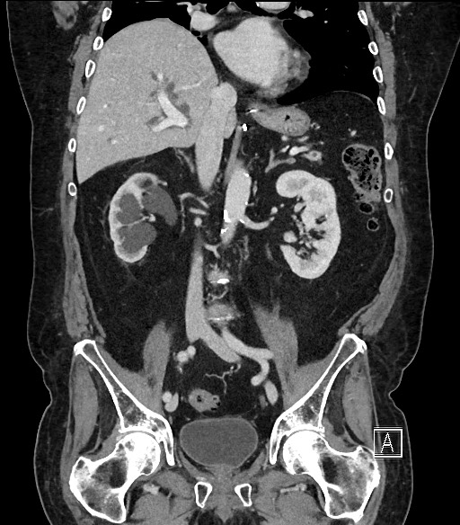 File:Ampullary adenocarcinoma (Radiopaedia 59373-66734 D 59).jpg