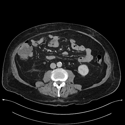 Ampullary adenocarcinoma (Radiopaedia 59373-66737 A 92).jpg