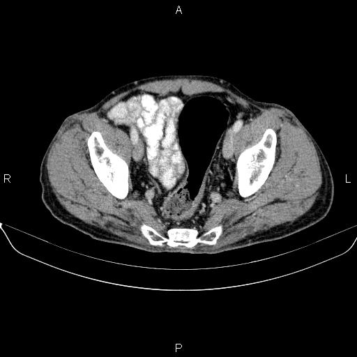 Ampullary adenocarcinoma (Radiopaedia 86093-102032 A 49).jpg