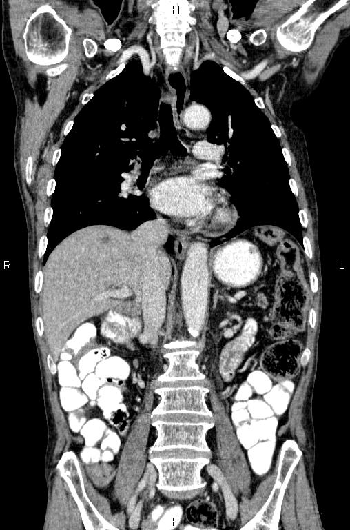Ampullary adenocarcinoma (Radiopaedia 86093-102033 D 33).jpg