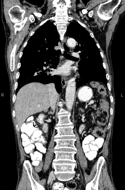 Ampullary adenocarcinoma (Radiopaedia 86093-102033 D 36).jpg