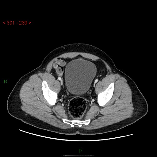 Ampullary carcinoma (Radiopaedia 56396-63056 C 87).jpg