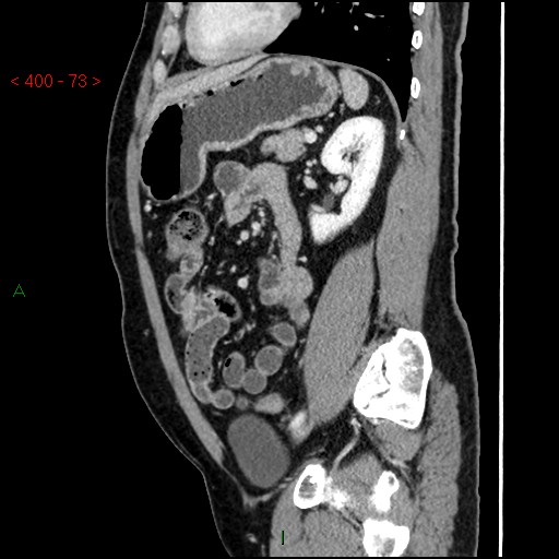 Ampullary carcinoma (Radiopaedia 56396-63056 D 72).jpg