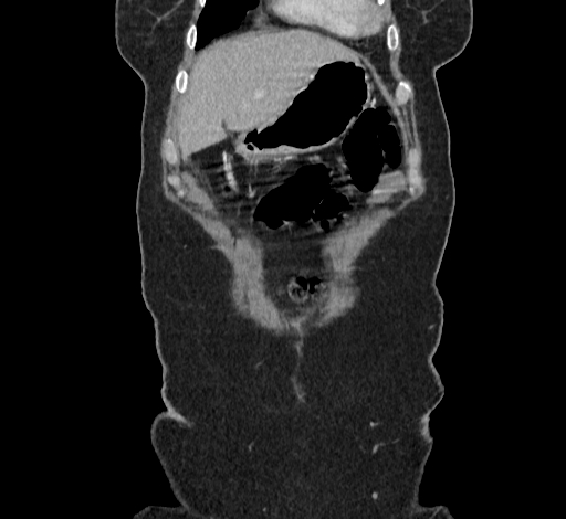 Ampullary tumor (Radiopaedia 60333-67998 B 8).jpg