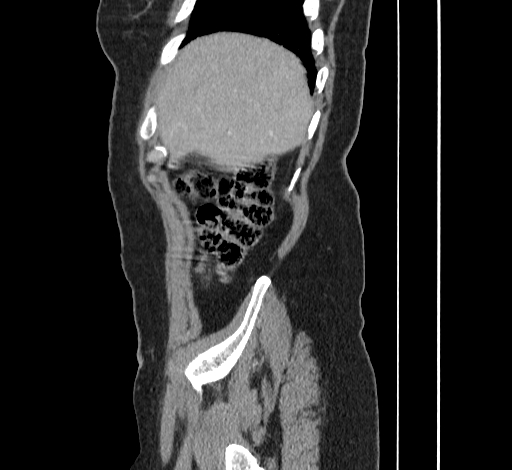 File:Ampullary tumor (Radiopaedia 60333-67998 C 5).jpg