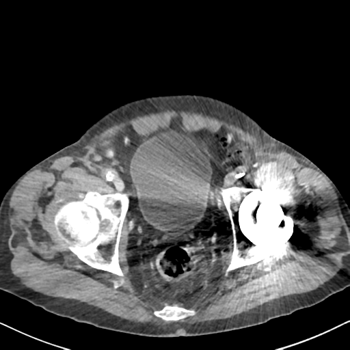 File:Amyand hernia (Radiopaedia 39300-41547 A 66).png