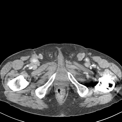 File:Amyand hernia (Radiopaedia 39300-41547 A 79).png