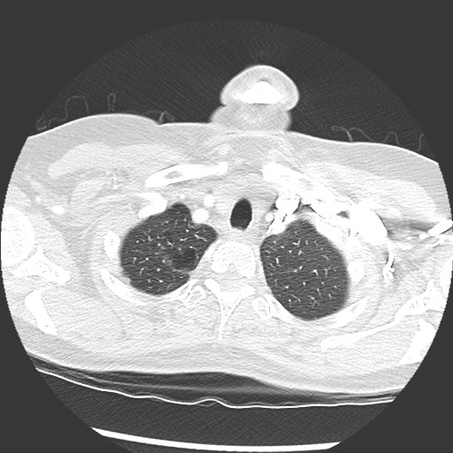 Amyloidosis - bronchial and diffuse nodular pulmonary involvement (Radiopaedia 60156-67745 Axial lung window 6).jpg