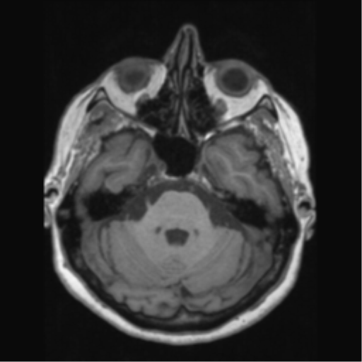 Anaplastic astrocytoma IDH wild-type (pseudoprogression) (Radiopaedia 42209-45276 Axial T1 49).png