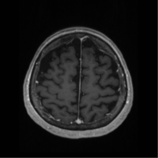 File:Anaplastic astrocytoma IDH wild-type (pseudoprogression) (Radiopaedia 42209-45276 Axial T1 C+ 117).png