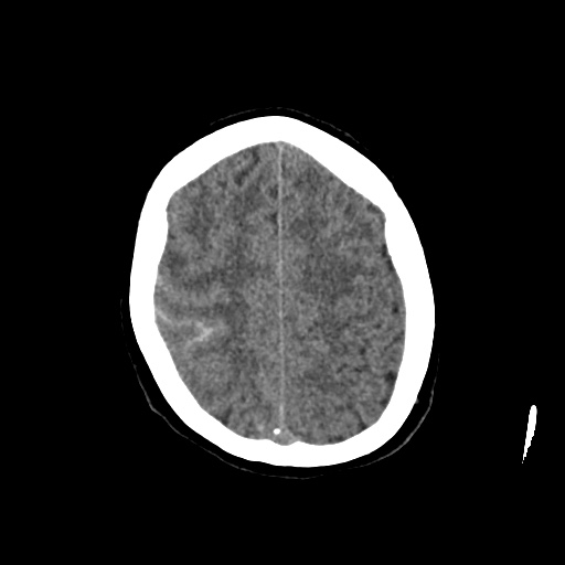 Aneursym related subarachnoid hemorrhage with hydrocephalus (Radiopaedia 45105-49083 Axial non-contrast 39).jpg