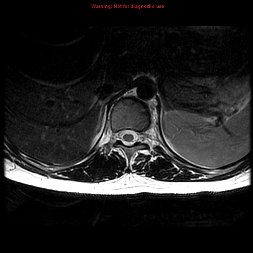 File:Aneurysmal bone cyst (Radiopaedia 9419-10103 Axial T2 16).jpg