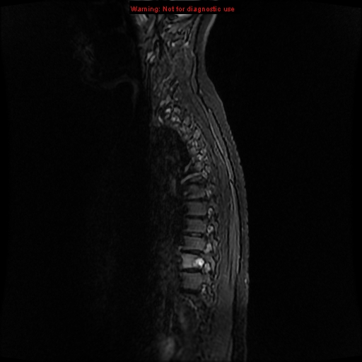 File:Aneurysmal bone cyst (Radiopaedia 9419-10103 Sagittal T2 1).jpg