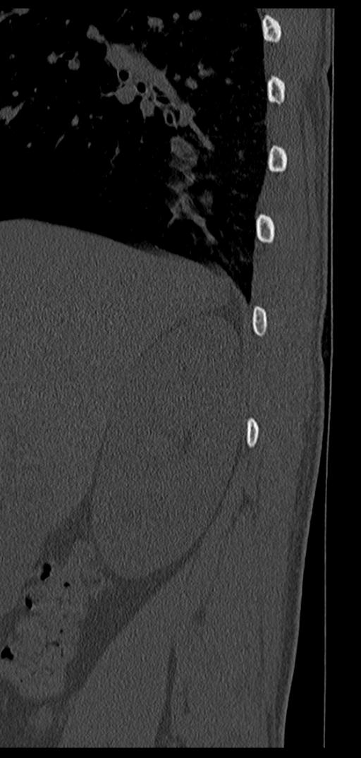 Aneurysmal bone cyst T11 (Radiopaedia 29294-29721 Sagittal bone window 79).jpg