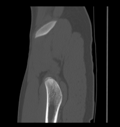 Aneurysmal bone cyst of ischium (Radiopaedia 25957-26094 Sagittal bone window 10).png