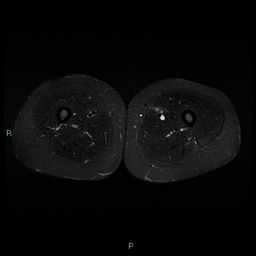 Angioleiomyoma (Radiopaedia 85442-101078 Axial STIR 45).jpg