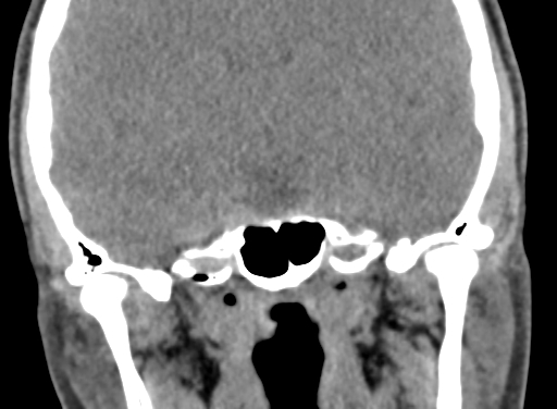 Angular dermoid cyst (Radiopaedia 88967-105790 Coronal non-contrast 65).jpg