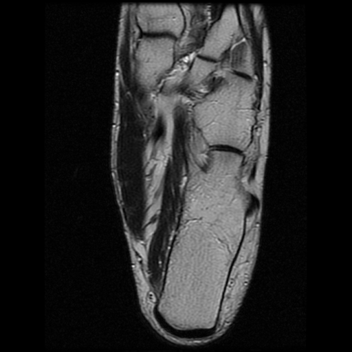 File:Anterior calcaneal process fracture (Radiopaedia 74654-85611 Axial T2 22).jpg