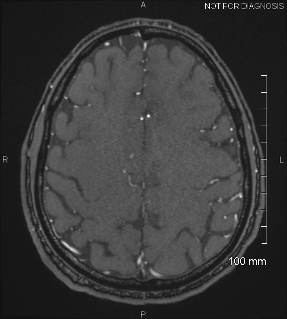 Anterior cerebral artery aneurysm (Radiopaedia 80683-94127 Axial MRA 191).jpg