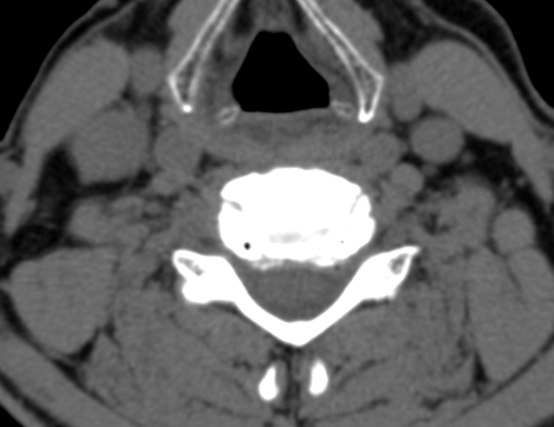 Anterior cervical postdiscectomy arthrodesis (Radiopaedia 32678-33646 Axial non-contrast 47).jpg