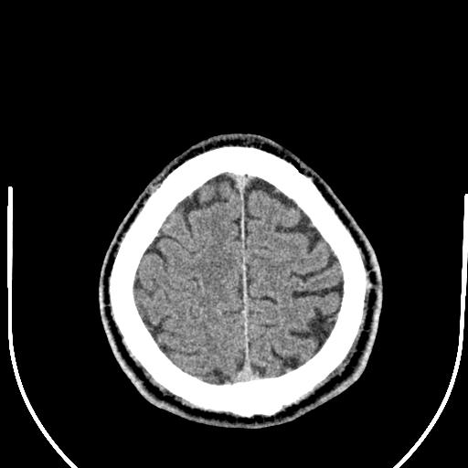 Anterior choroidal artery infarct (Radiopaedia 55106-61480 Axial non-contrast 53).jpg