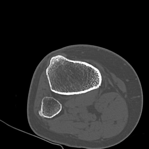 File:Anterior cruciate ligament avulsion fracture (Radiopaedia 58939-66194 Axial bone window 32).jpg