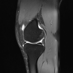 File:Anterior cruciate ligament full thickness tear (Radiopaedia 66268-75467 Sagittal PD fat sat 9).jpg