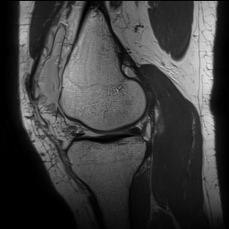 Anterior cruciate ligament rupture with Segond fracture (Radiopaedia 69043-78806 Sagittal PD 73).jpg