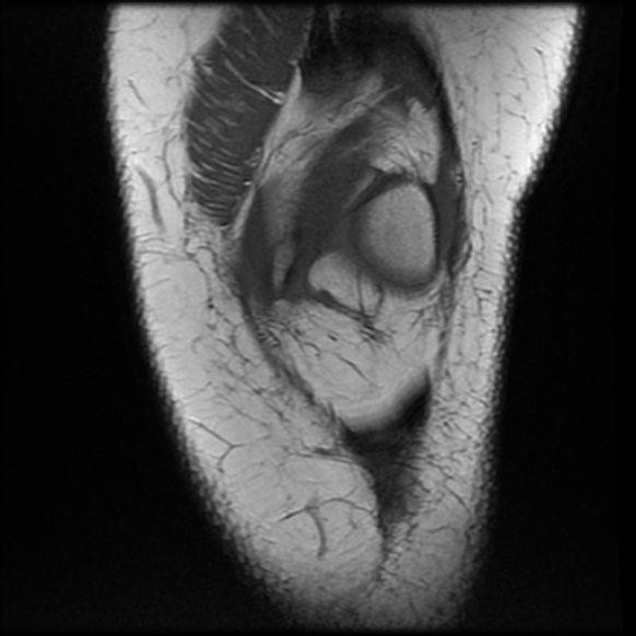 File:Anterior cruciate ligament tear, Wrisberg rip and bucket-handle tear of medial meniscus (Radiopaedia 75872-87266 Coronal T1 7).jpg