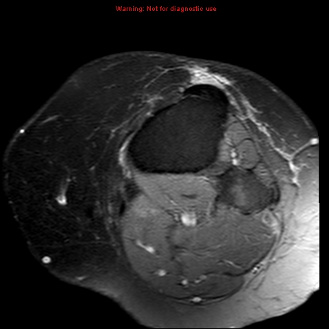 File:Anterior cruciate ligament tear (Radiopaedia 12329-12612 Axial T2 fat sat 1).jpg