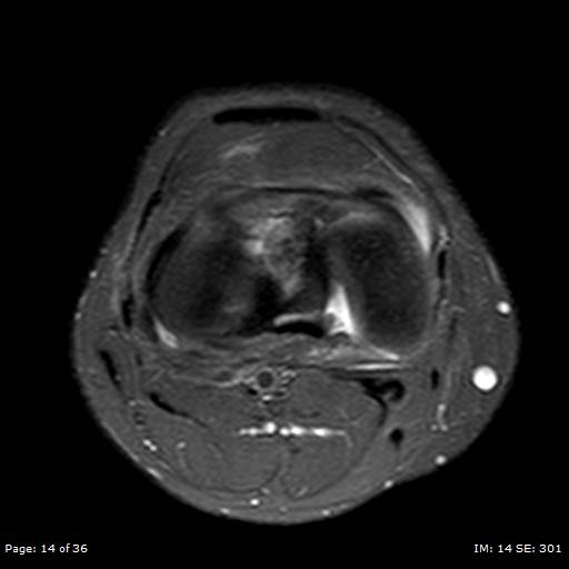 File:Anterior cruciate ligament tear (Radiopaedia 70783-80964 Axial PD fat sat 14).jpg