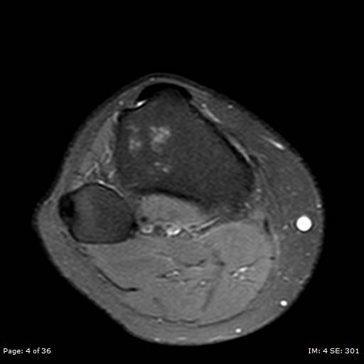 File:Anterior cruciate ligament tear (Radiopaedia 70783-80964 Axial PD fat sat 4).jpg