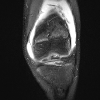 File:Anterior cruciate ligament tear - pediatric (Radiopaedia 62152-70260 Coronal PD fat sat 20).jpg
