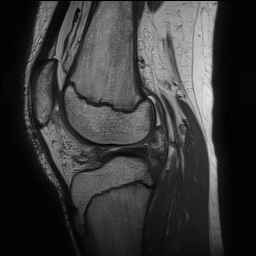 File:Anterior cruciate ligament tear - pediatric (Radiopaedia 62152-70260 Sagittal PD 105).jpg