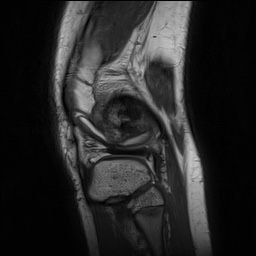 File:Anterior cruciate ligament tear - pediatric (Radiopaedia 62152-70260 Sagittal PD 146).jpg
