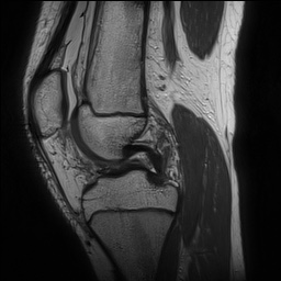 Anterior cruciate ligament tear - pediatric (Radiopaedia 62152-70260 Sagittal PD 80).jpg