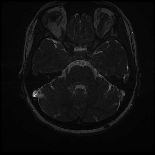 Anterior inferior cerebellar artery vascular loop - type II (Radiopaedia 70991-81209 Axial 3D FIESTA 15).jpg