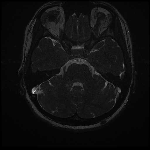 Anterior inferior cerebellar artery vascular loop - type II (Radiopaedia 70991-81209 Axial 3D FIESTA 16).jpg