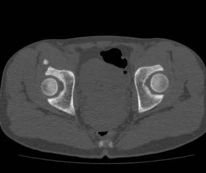 Anterior inferior iliac spine avulsion fracture (Radiopaedia 81312-94999 Axial bone window 51).jpg