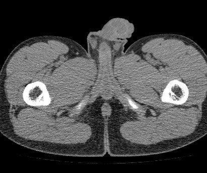 File:Anterior inferior iliac spine avulsion fracture (Radiopaedia 81312-94999 Axial non-contrast 75).jpg