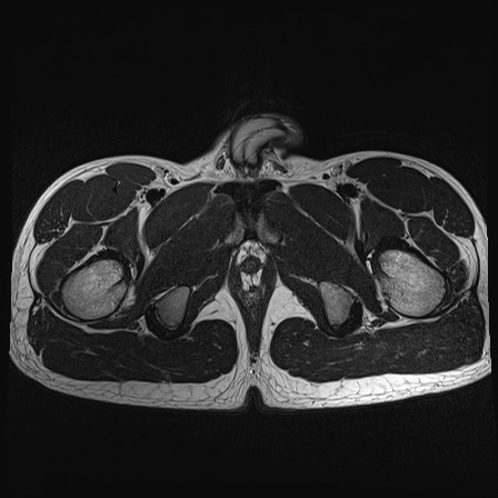 File:Anterior inferior iliac spine avulsion fracture (Radiopaedia 81312-95000 Axial T2 6).jpg