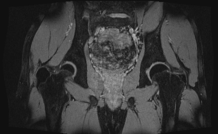 Anterior inferior iliac spine avulsion fracture (Radiopaedia 81312-95000 G 26).jpg