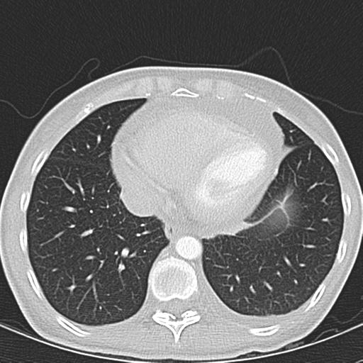 Anterior mediastinal lymphoma (Radiopaedia 29556-30061 Axial lung window 42).jpg