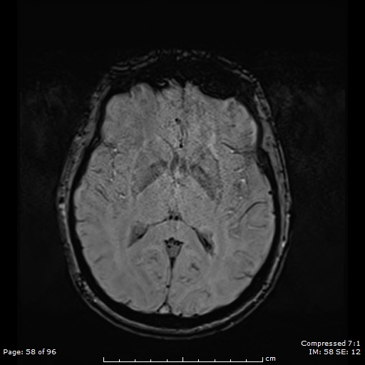 Anterior temporal lobe perivascular space (Radiopaedia 88283-104914 Axial SWI 27).jpg