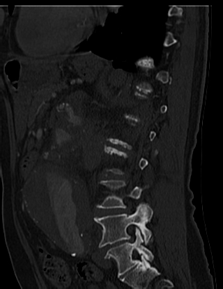 File:Anterior vertebral scalloping (abdominal aortic aneurysm) (Radiopaedia 66744-76067 Sagittal bone window 61).jpg