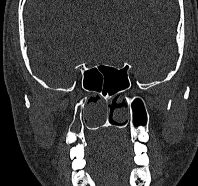 Antrochoanal polyp (Radiopaedia 30002-30554 Coronal bone window 54).jpg