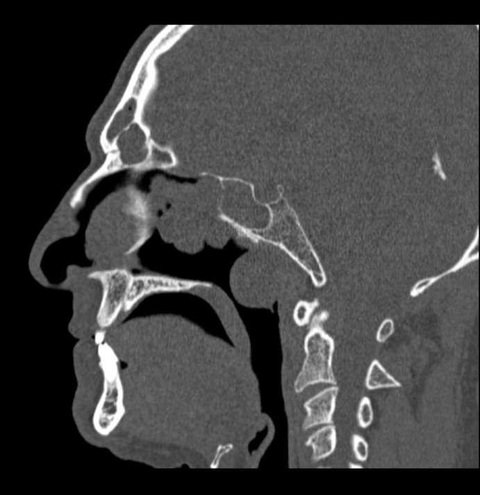 Antrochoanal polyp (Radiopaedia 79011-92169 Sagittal bone window 33).jpg