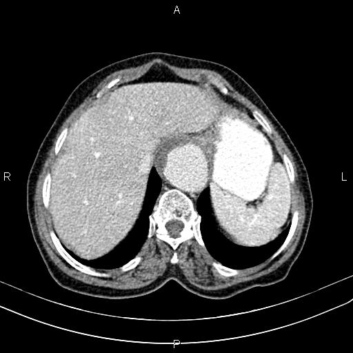 File:Aortic aneurysm and Lemmel syndrome (Radiopaedia 86499-102554 A 16).jpg