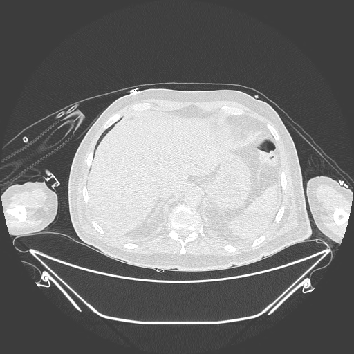 Aortic arch aneurysm (Radiopaedia 84109-99365 Axial lung window 247).jpg