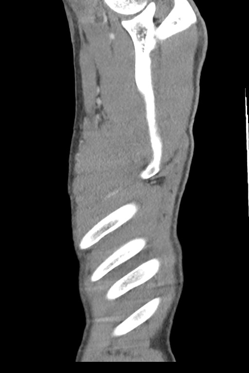 Aortic coarctation with aneurysm (Radiopaedia 74818-85828 B 150).jpg